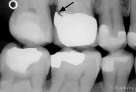 recurrent-caries-secondary-tooth-decay-pfm-crown
