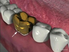 Recurrent dental caries (tooth decay) around a gold crown.