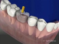 Cleaning, shaping, and enlarging the root canals.