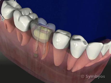 root-canal-with-structural-posts