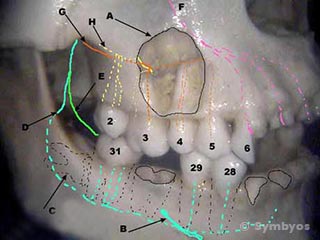 roots-back-teeth-sinus-sinusitis-toothache-pain-320