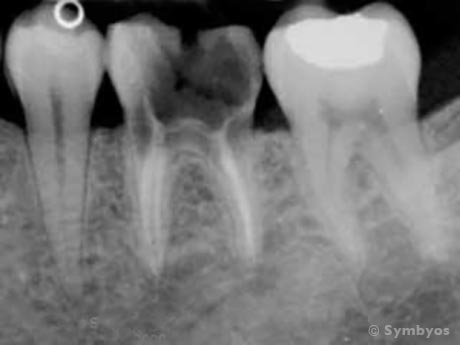 A large cavity in this rotten molar tooth makes it unrestorable. The prognosis is considered "hopeless."