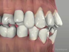 Secondary occlusal trauma can occur with normal chewing forces it the teeth have experienced periodontal attachment loss.