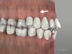 simple tooth removal - straight roots are best.
