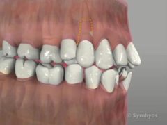 Simple tooth extraction: loosening attachment fibers