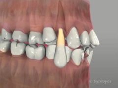 Simple tooth extraction: loosening, elevation, and delivery.