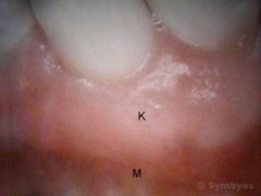 A soft tissue graft (periodontal surgery) covered sensitive tooth root.