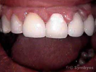Gingivitis due to poor oral hygiene causes enlarged swollen painful and bleeding gums.