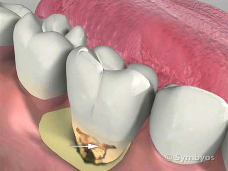 Sub gingival (below the gums) calculus caused by bacterial plaque that remained too long on the tooth.
