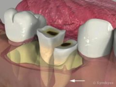 A dilacerated root on this unrestorable lower molar tooth makes surgical extraction necessary.