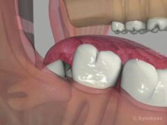Impacted wisdom teeth such as this require surgical tooth extractions to be removed without trauma.