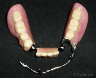 swinglock-removable-partial-denture-tooth-loss-edentulism