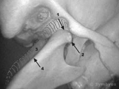 TMJ (temporomandibular joint) jaw anatomy derangements can cause a pop, lock or click.