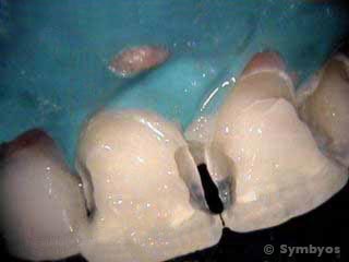 Softened tooth enamel removed after severe demineralization from meth abuse.