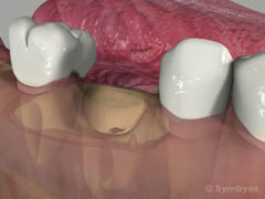 Lower molar tooth extraction socket after removal shows twin roots and alveolar bone.