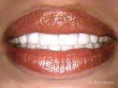 Veneers over tetracycline stained teeth.