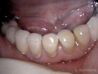 Composite resin fillings in worn lower teeth can restore them cosmetically and functionally.