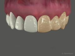 Whitened teeth (left) can dramatically improve your smile and self-confidence.