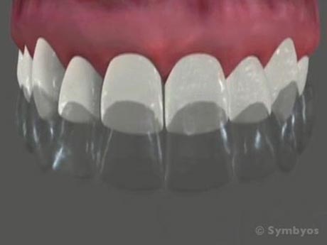 tooth-whitening-06-whitened-teeth-460