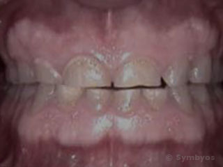 worn-teeth-attrition-bruxism-320