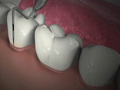 periodontal-maintenance-toothiq-384