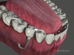 Denture symptoms