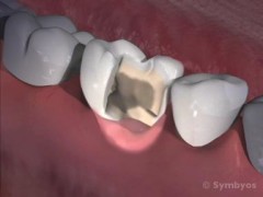 Tooth damage symptoms