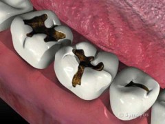 Tooth decay symptoms