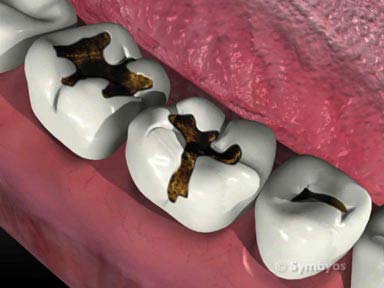 dental-symptom-tooth-decay-toothiq-384