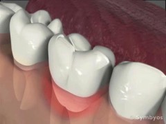 Lateral Periodontal Abscess