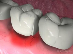 Poorly Contoured Dental Restorations