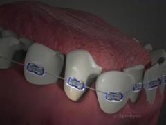 Oral Hygiene for Braces thumbnail