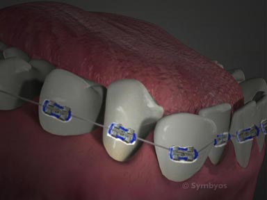 Oral Hygiene for Braces and Bridges thumbnail