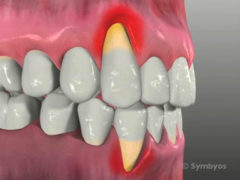 Preventing Receded Gums thumbnail