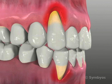 prevention-preventing-receded-gums-toothiq-384