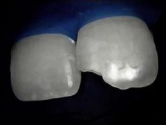 Preventing Tooth Injuries thumbnail