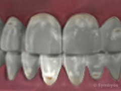 Tooth Enamel Demineralization