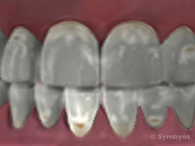 tooth-enamel-demineralization-toothiq-384
