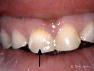 Severe enamel demineralization from chronic exposure to acids.