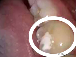 Molar tooth eroded by chronic exposure to stomach acid.