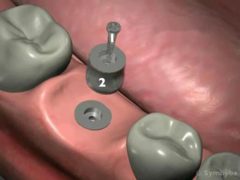 Dental implant abutments are fastened to the fixture with a retaining screw.