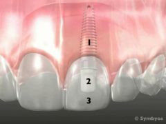 A transparent view showing a dental implant with ceramic abutment restored with a porcelain crown.