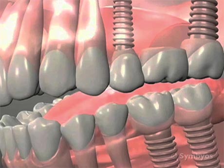 dental-implants-replace-natural-teeth