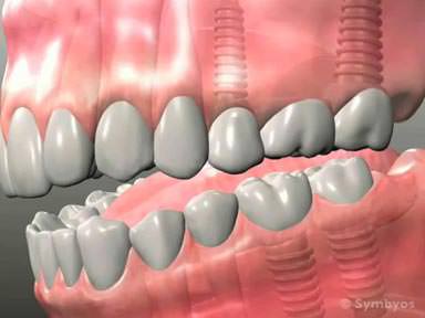 dental-implants-toothiq-384