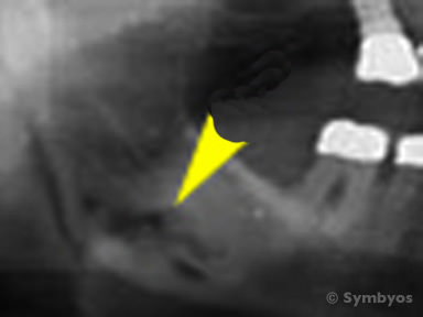 jaw-cysts-toothiq-384