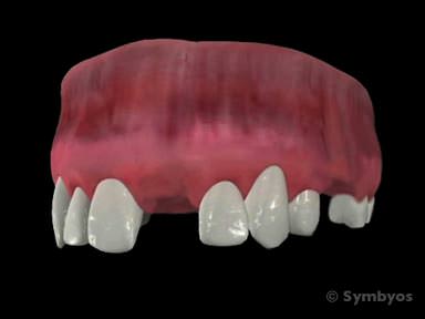 missing-teeth-toothiq-384