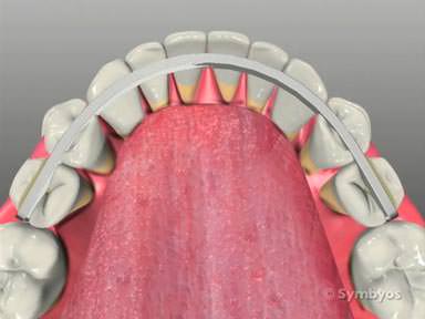 periodontal-stabilization-splints-toothiq-384