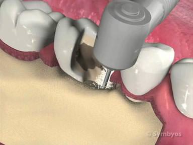 periodontal-surgery-toothiq-384