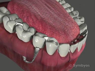removable-dentures-toothiq-384