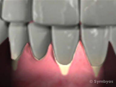 sensitive-teeth-toothiq-384